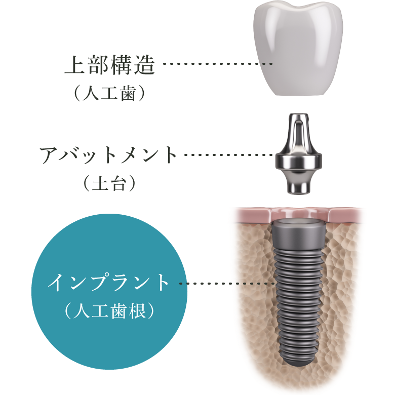 インプラント（人工歯根）