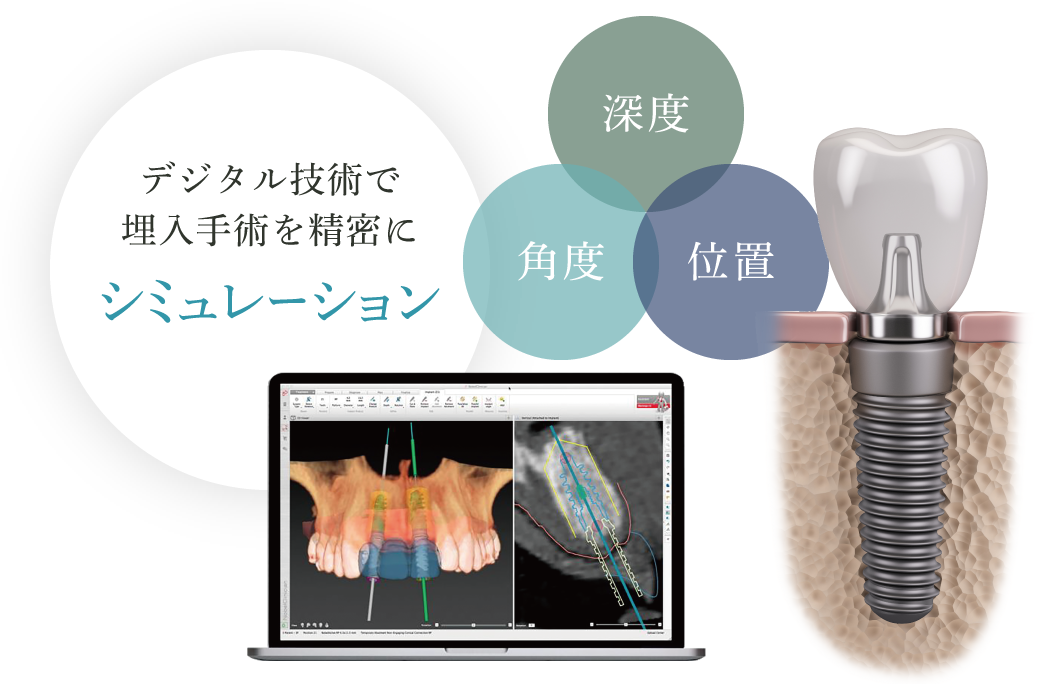 デジタル技術で埋入手術を精密にシミュレーション