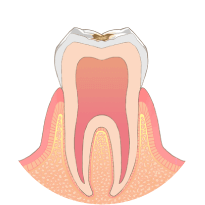 歯の表面に虫歯ができます