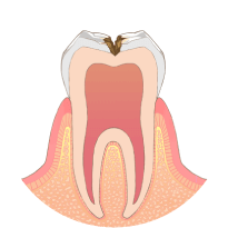 虫歯が神経に近くなり、冷たいものがしみます
