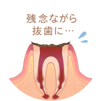 神経が死んでしまい、痛みを感じなくなります